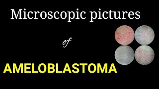 Microscopic histology of ameloblastoma microscopic pictures of oral pathology Dr Poojireddy [upl. by Eirrem368]