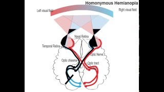 homonemous hemianopia [upl. by Manolo]