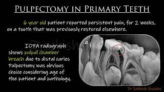 Pulpectomy in Primary Teeth [upl. by Namajneb170]