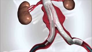 Aneurysms  causes symptoms diagnosis treatment pathology [upl. by Barrie844]