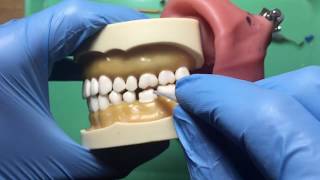 Checking Occlusal Clearance in the NDEB ACS Exam [upl. by Hanid]