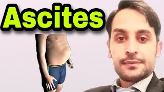 Ascites  Causes  Symptoms  Diagnosis  Treatment [upl. by Ezarras123]