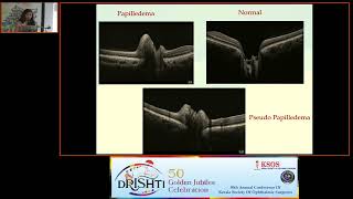 KSOS2023 Dr Rehna Rasheed FP214 Papilledema Vs Pseudopapilledema A Qualitative analysis of swo [upl. by Snashall115]