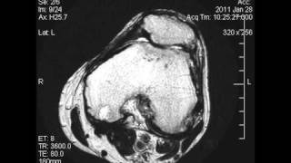 MRI left knee 01 [upl. by Arytahs]