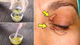 Xanthelasma removal at home  Home remedy to get rid of cholesterol deposits around your eyes natura [upl. by Nyl]