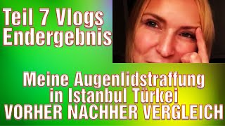 Augenlidstraffung Türkei Erfahrung Lidstraffung Vorhher Nachher Bilder Medical Exclusive Istanbul [upl. by Walczak]