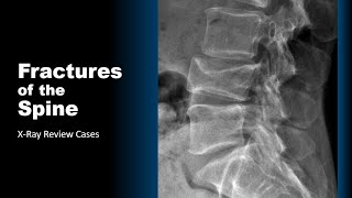 Fractures of the Spine XRay Cases radiology spine trauma doctor [upl. by Watt]