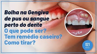 Bolha na Gengiva de pus ou sangue perto do dente O que pode ser Tem remédio caseiro Como tirar [upl. by Etyak972]