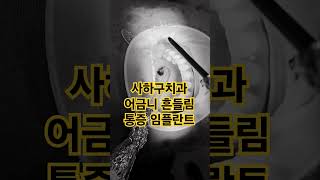 사하구치과 어금니 흔들림 통증 임플란트 [upl. by Holmen73]