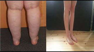 how to get rid of cankles without surgery [upl. by Aicilla946]