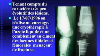 Hémangioendothéliome épithélioïde multifocal du membre inférieur [upl. by Katherina]