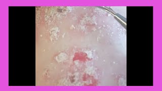 Plaque Psoriasis Removal  How to remove psoriasis [upl. by Atterahs]