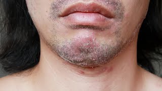 Facial Psoriasis  Causes and How To Treat It [upl. by Greenstein]