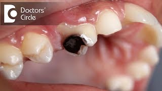 What problems can be caused due to cavities if left untreatedDr Jayaprakash Ittigi [upl. by Ronni]