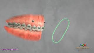 Orthodontic Treatment for Gummy Smile  TAD and Elastics [upl. by Limoli418]