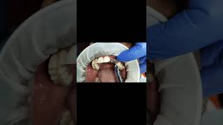 2 implants for maxillary incisor and canine tapping test after 6 monthssingle piece basal implants [upl. by Anihpesoj425]