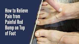 PAIN RELIEF FOR RED BUMP ON TOP OF FOOT [upl. by Emarie830]