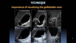 Basic Gallbladder [upl. by Pence403]