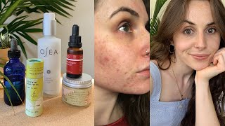 My Skin Care Routine amp How I Cleared my Acne Without Fancy Products  minimalist amp low waste [upl. by Llirrehs]