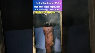 laser treatment of varicose veins Varicose veins treatment in Ranchi shirts varicoseveins [upl. by Ilah822]