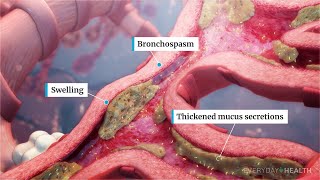 What Is Severe Asthma [upl. by Eiramait]