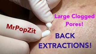 Deep clogged pores on the back extracted Blackhead removal up close by the dozens [upl. by Shaner560]