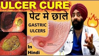 Rx Digestion 6 Hindi पेट मे अल्सर छाले Peptic Gastric amp Duodenal Ulcers  by DrEducation [upl. by Analim]