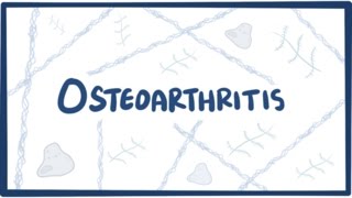 Osteoarthritis  causes symptoms diagnosis treatment amp pathology [upl. by Krishnah]