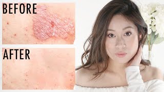 Psoriasis  How To Get Rid of Itchy Scaly Skin  Vivienne Fung [upl. by Alanna]