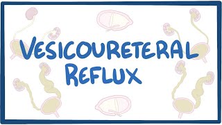 Vesicoureteral reflux  causes symptoms diagnosis treatment pathology [upl. by Brindell]