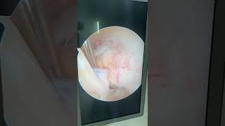 ACL ganglion cystkeyhole surgery arthroscopic decompression kneearthroscopy acl ganglioncyst [upl. by Sproul42]