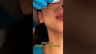 CO2 Laser Changed My Skin😱 acne acnescars beauty [upl. by Ovida]