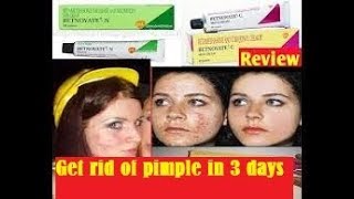 Betnovate cream Review in Tamil  uses  side effectsget rid of pimples in 3 days [upl. by Senaj]