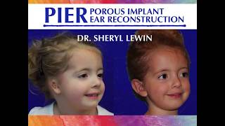 Dr Sheryl Lewins Lecture on Porous Implant Ear Reconstruction  LAMAC 2017 [upl. by Anilas]