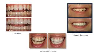 Dept Of Prosthodontics Lec1 Introduction To Fixed Partial Denture [upl. by Ahsienor]