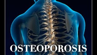 Osteoporosis in Thalassemia Early Symptoms Causes Treatments Prevention and More [upl. by O'Rourke]