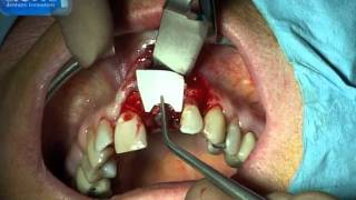 actis dentaire formation  avulsion implantation immédiate ROG immediate implant placement GBR [upl. by Matthiew]