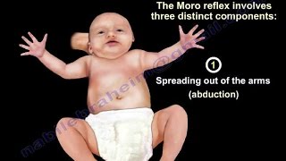 514  Primitive Reflexes Moro Reflex  3 Months  Infant Clinical Examination MRCP [upl. by Sidnak]