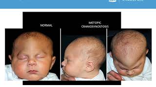 Neurosurgery Medical Student Primer  Craniosynostosis [upl. by Einahpet813]