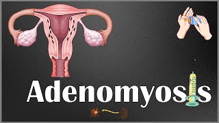 Adenomyosis  Definition Causes Risk Factors Signs amp Symptoms Diagnosis amp Treatment [upl. by Analli]