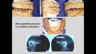 OrthodontieOcclusodontieFin de traitement version intégrale [upl. by Redneval]