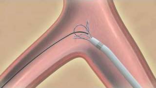 EN Snare® Endovascular Snare System [upl. by Jolenta]