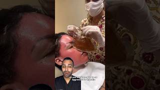 The most EXTREME Chemical Peel 😵 Dr Somji Reacts [upl. by Spears]