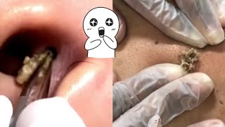 Ultimate Compilation Satisfying Blackhead Removal and Acne Treatment Highlights [upl. by Tandie]