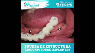 Prueba de Estructura Zirconio sobre implantes [upl. by Ikkiv]