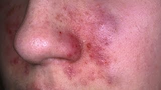 Eczema Dermatitis Treatment  The Benefits of Treating Eczema with Home Remedies [upl. by Konikow]