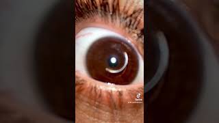 Eye drop Trend TikTok on Keratoconus [upl. by Kilbride]