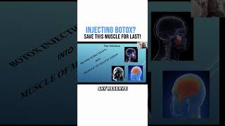 Injecting Botox Save THIS Muscle for Last [upl. by Ieso]