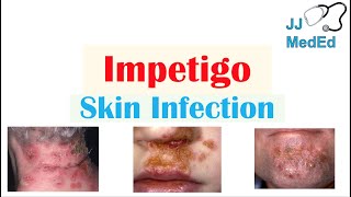 Introduction to Impetigo  Infection Subtypes and Treatment [upl. by Zoltai]