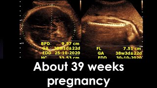 Practical ultrasound case  About 39 weeks pregnancy [upl. by Aeniah]